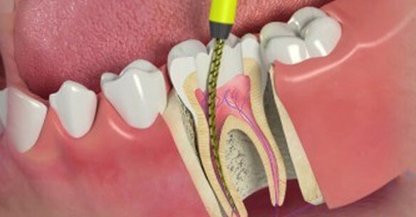 Root-Canal-Treatment Composite Fillings
