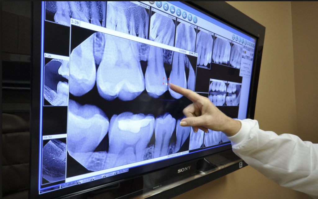Screenshot-2018-03-13-10.49.17-1080x675-1024x640 Composite Fillings