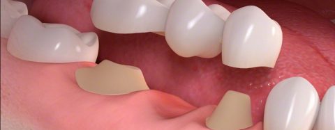 dental_bridge_sm-480x187 Composite Fillings