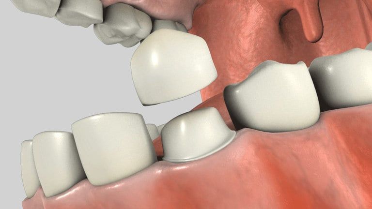 porcelain_crown-xs Composite Fillings