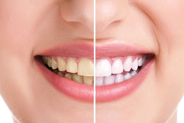 teeth-whitening
