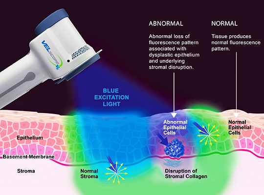 velscope Composite Fillings