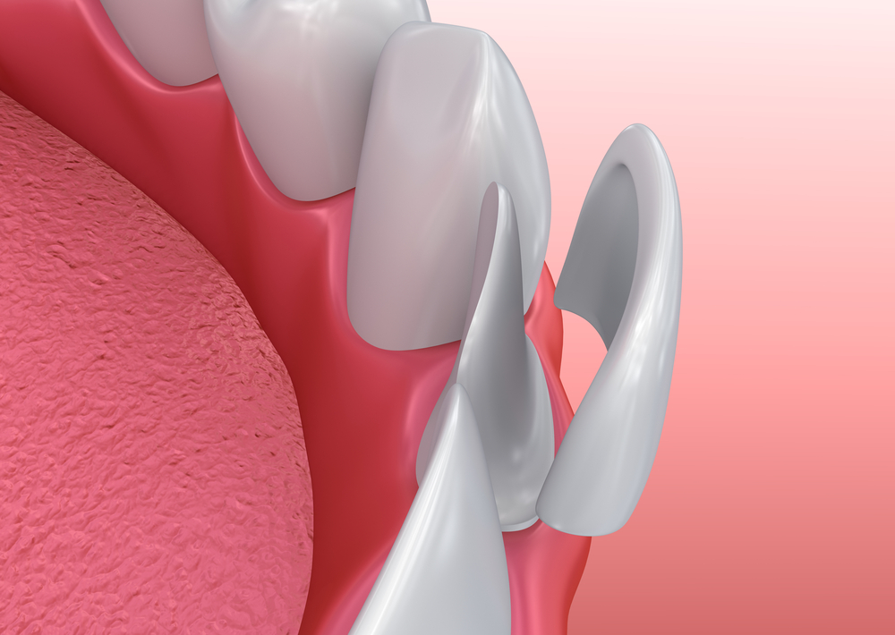 veneers-raleigh Composite Fillings