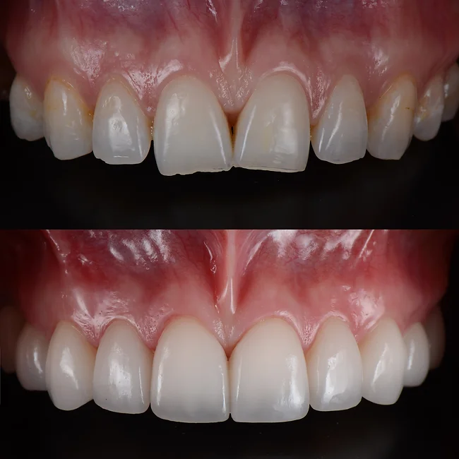 dentistsatmetrotown services dental bonding1