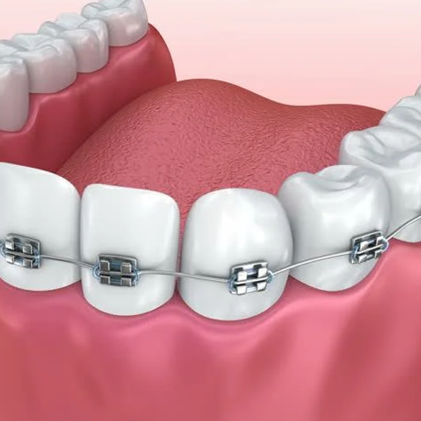 dentistsatmetrotown services dental braces1