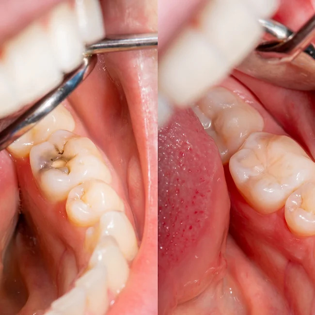 dentistsatmetrotown services dental filling