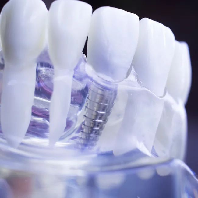 dentistsatmetrotown services dental implants1