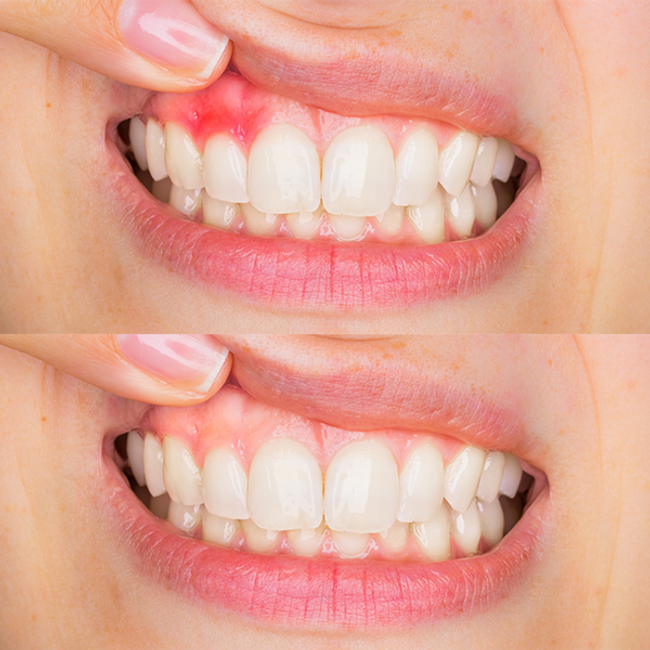 dentistsatmetrotown services gum disease before after