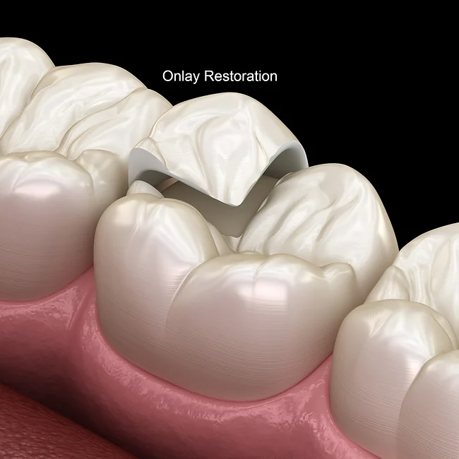 dentistsatmetrotown services inlays onlays