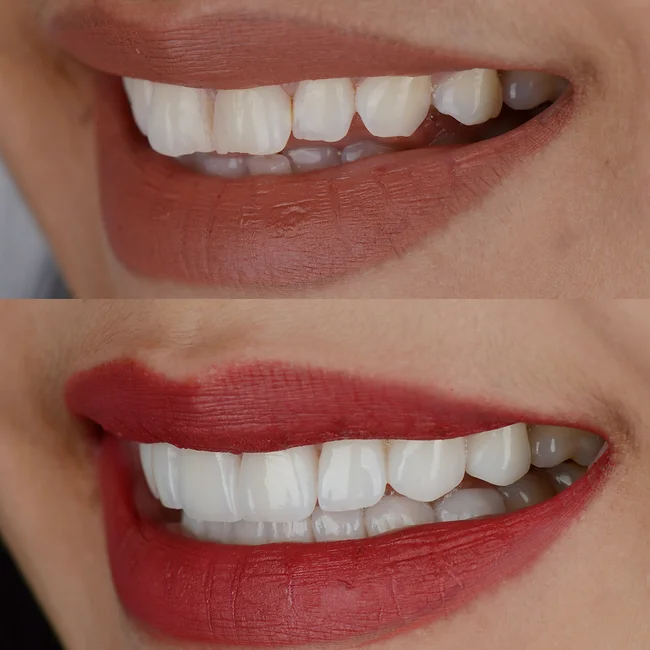 dentistsatmetrotown services porcelain veneers1