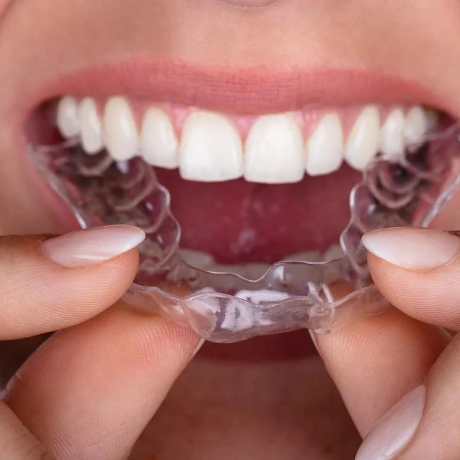 dentistsatmetrotown services retainers1