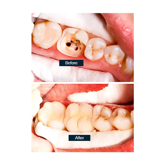 dentistsatmetrotown services root canal1