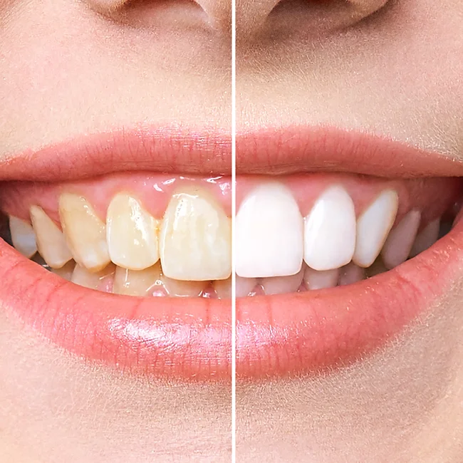 dentistsatmetrotown services teeth whitening