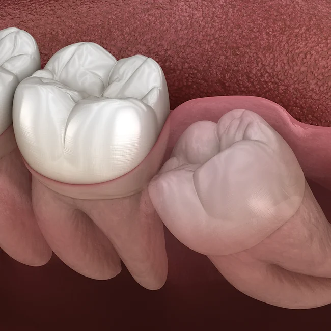 dentistsatmetrotown services wisdom teeth removal1