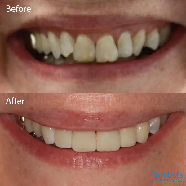 dentistsatmetrotown gallery before after 6 porcelain veneers