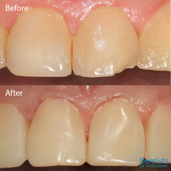 dentistsatmetrotown gallery before after composite restoration 1