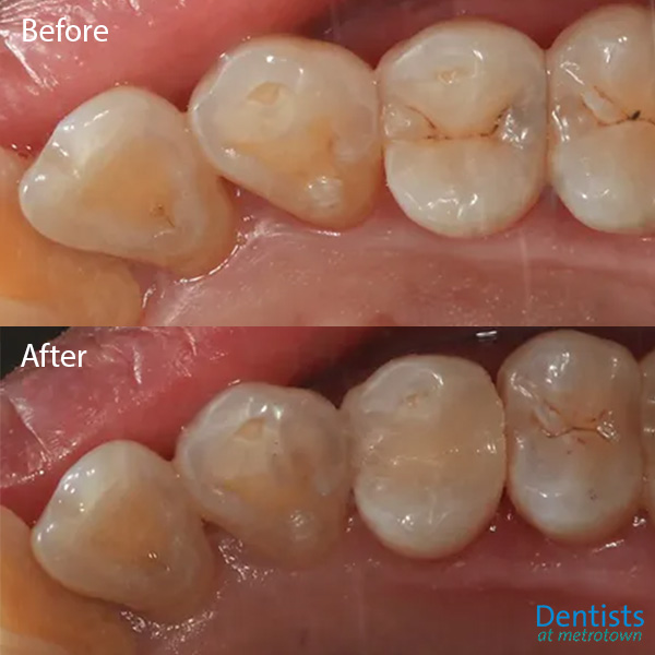 dentistsatmetrotown gallery before after composite restoration 2