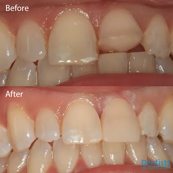 dentistsatmetrotown gallery before after composite restoration 3
