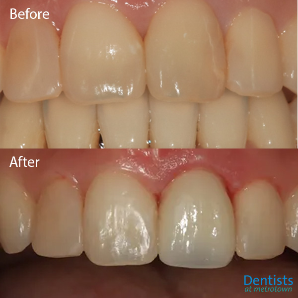 dentistsatmetrotown gallery before after composite restoration 4