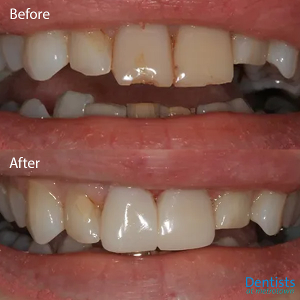 dentistsatmetrotown gallery before after composite restoration 5