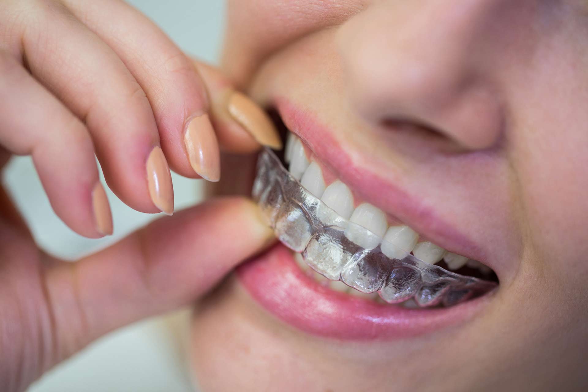 dentistatmetrotown blog discover the amazing benefits of invisalign for a perfect smile