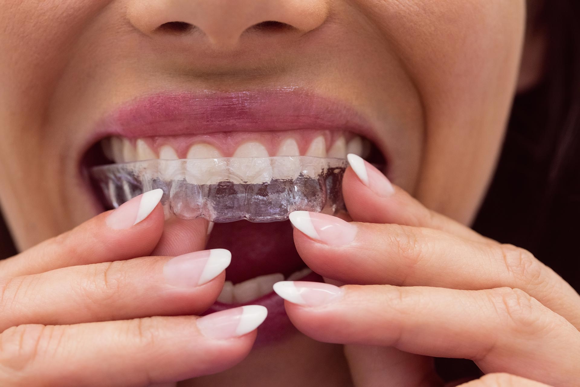 dentistatmetrotown blog invisalign benefits for adults in burnaby bc