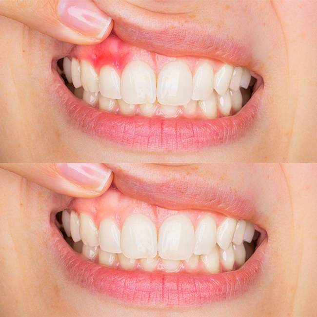 dentistsatmetrotown services gum disease before after