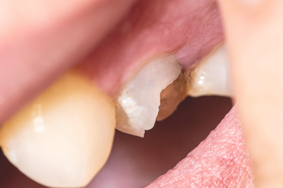 chipped tooth