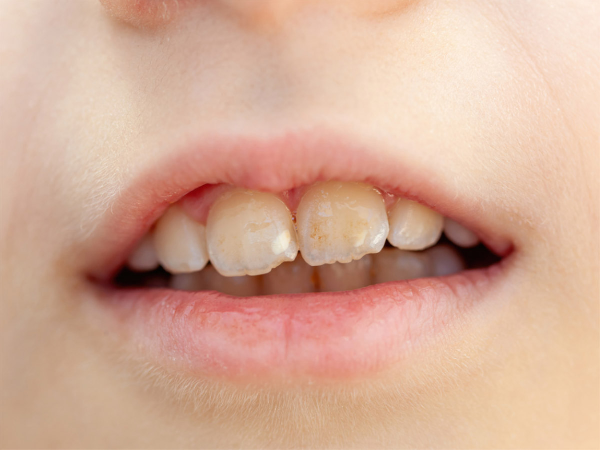 Dental acid erosion causing visible enamel wear on front teeth