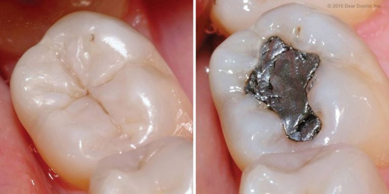 fillings-1024x512-768x384 Composite Fillings