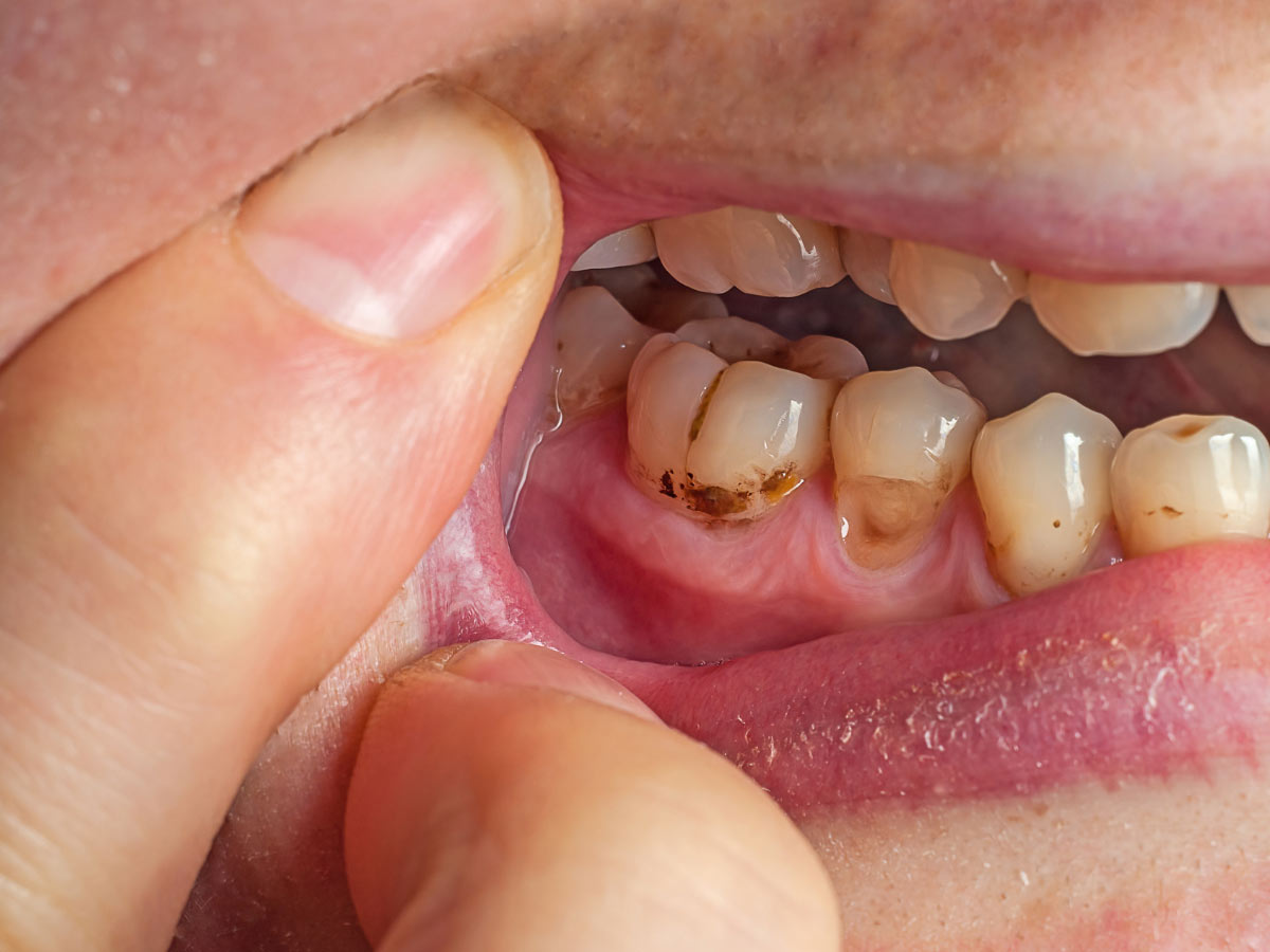Smoking Affects Dental Implants